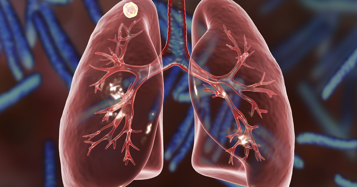 Lung Nodules Concern