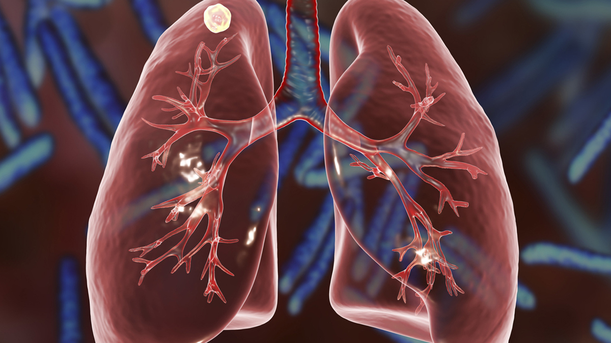 Lung Nodules And How They Relate To Lung Cancer El Camino Health