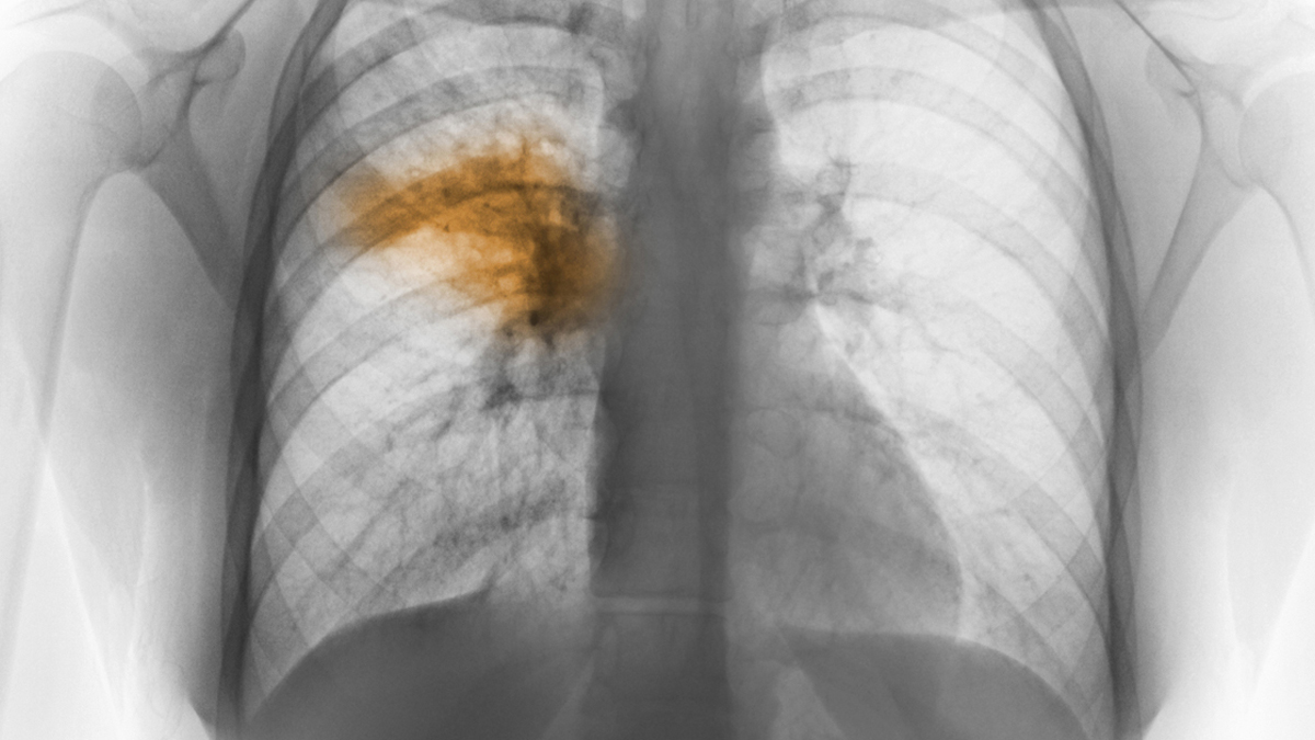 Pneumonia: And why it's a serious concern | El Camino Health