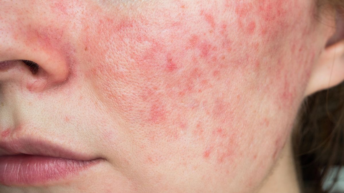 Rosacea: What Is It? Are You at Risk? | El Camino Health
