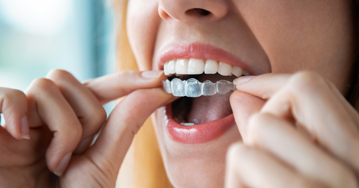 Teeth Aligners Do They Work? El Camino Health