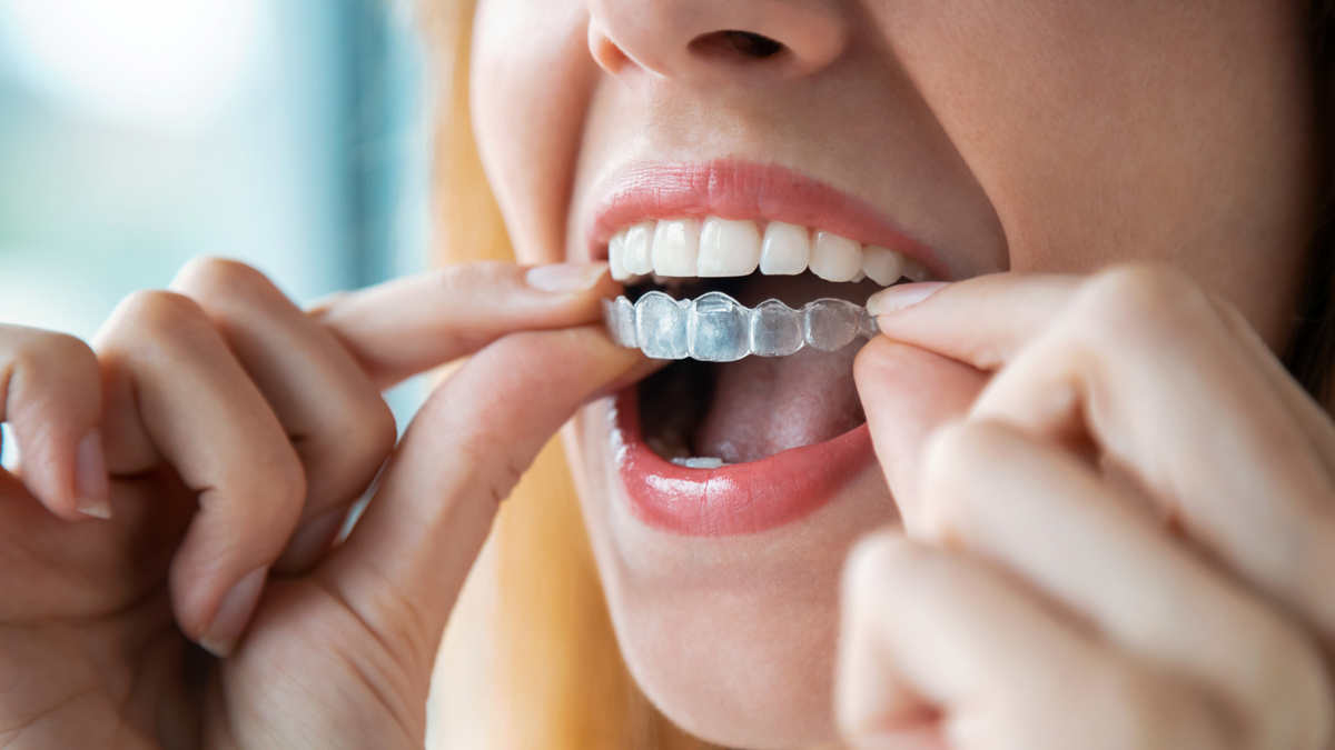 Teeth Aligners: Do They Work? | El Camino Health