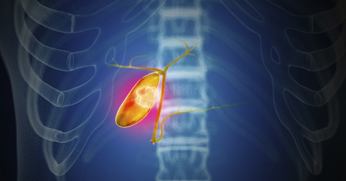 Gallbladder Attacks What You Should Know El Camino Health gallbladder-attacks-what-you-should-know-el-camino-health