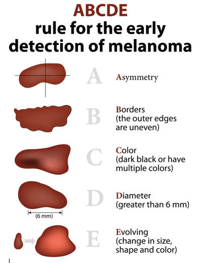 Melanoma