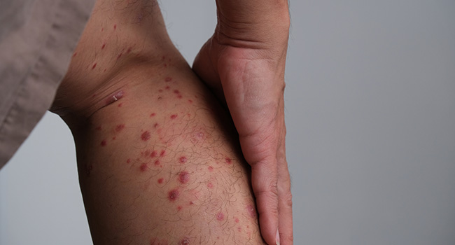 Close-up of an individual's leg with visible skin rash or irritation related to Guttate psoriasis