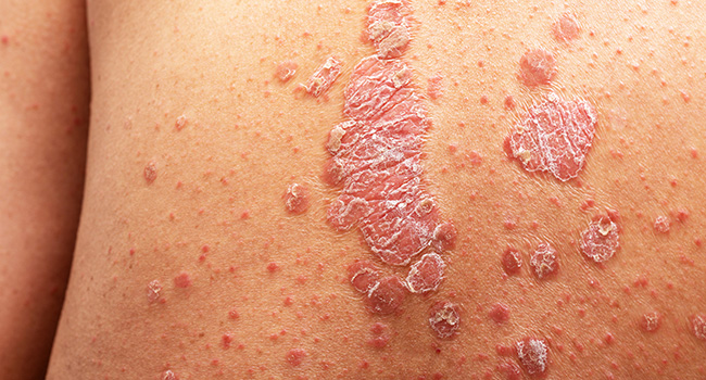Close-up image of red, scaly patches characteristic of Plaque psoriasis on human skin