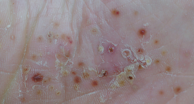 Detailed image of skin displaying red irritated bumps and flaky texture indicating Pustular psoriasis