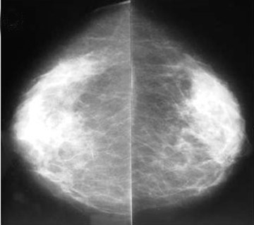 Dense Breast Tissue