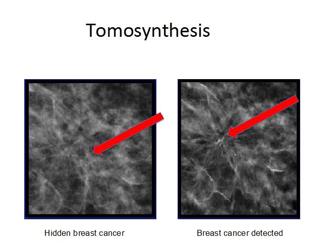 Tomosynthesis