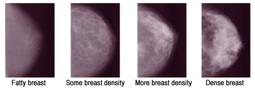 Breast Density