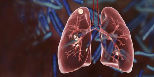 Lung Nodules and How They Relate to Lung Cancer