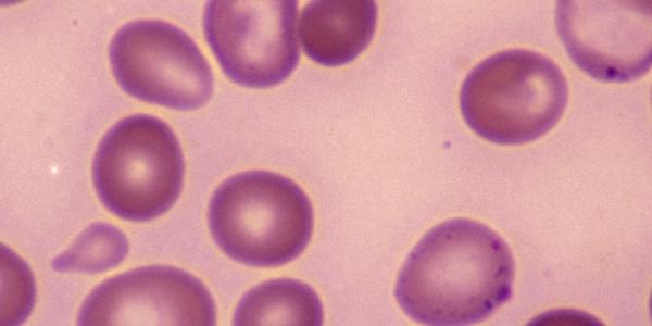 Signs and Symptoms: Anemia Signs and Symptoms: Anemia