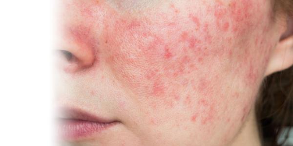 Rosacea