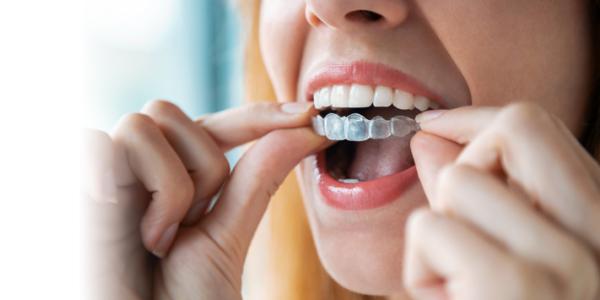 Teeth Aligners: Do They Work?