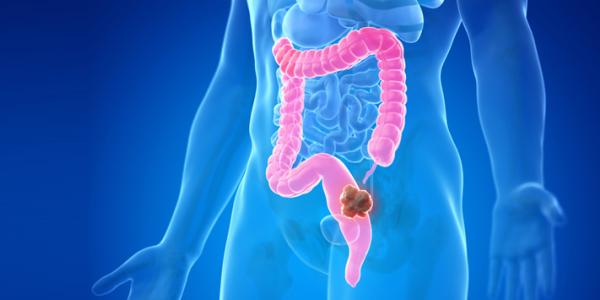 Screening and Prevention of Colorectal Cancer