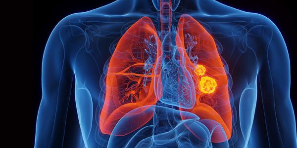 Lung Cancer Life Spans Leap from Months to Decades