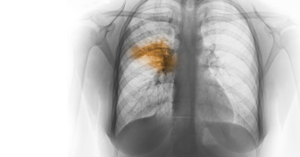 Pneumonia: And Why It's A Serious Concern | El Camino Health