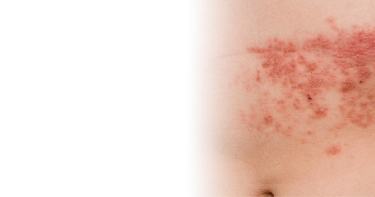 Shingles in Older Adults El Camino Health