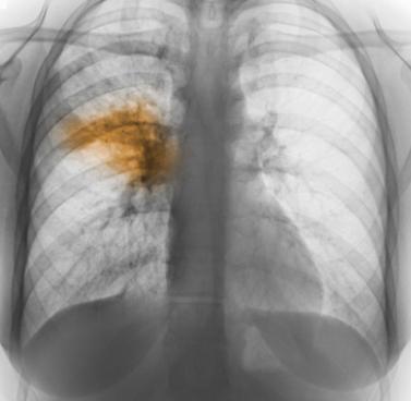 Pneumonia
