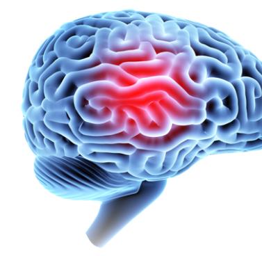 Concussions