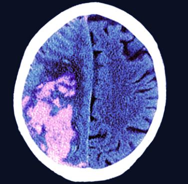 Stroke Awareness Month