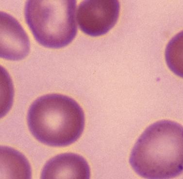 Signs and Symptoms: Anemia