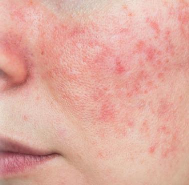 Rosacea