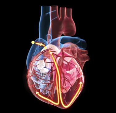 All About Atrial Fibrillation