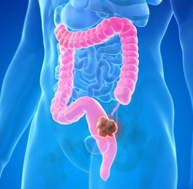 Screening and Prevention of Colorectal Cancer