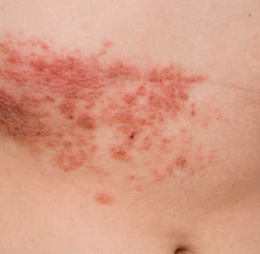Understanding Shingles