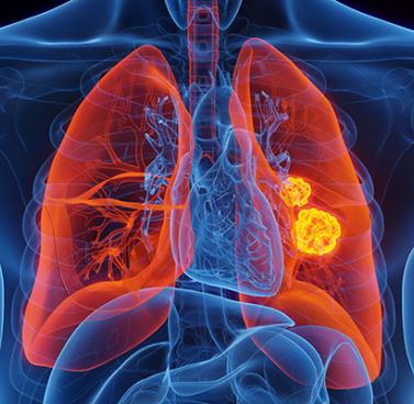 Lung Cancer Life Spans Leap from Months to Decades
